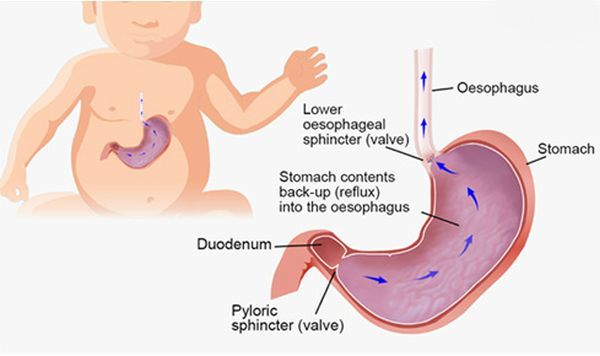 What is Infant Reflux?