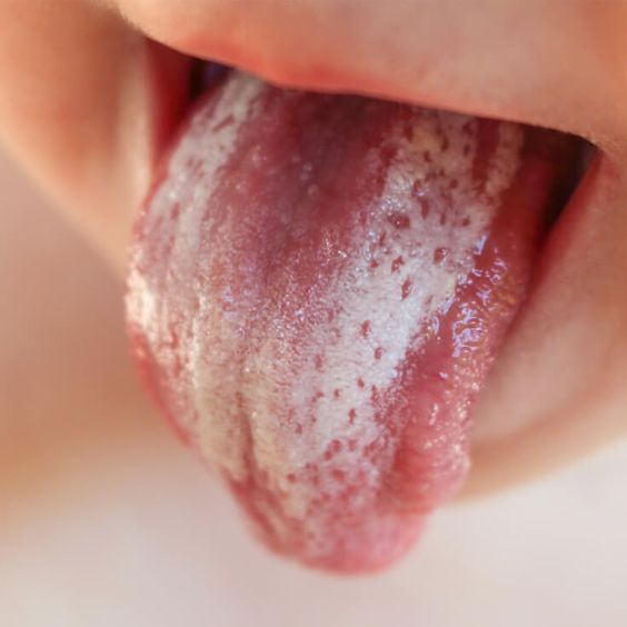 Oral thrush presents with a thicker, more stubborn white layer. - Thrush vs milk tongue in babies - Baby Journey blog