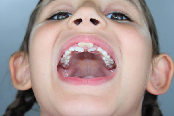 Child’s Shark Teeth - How to Fix Shark Teeth in Children - Baby Journey 