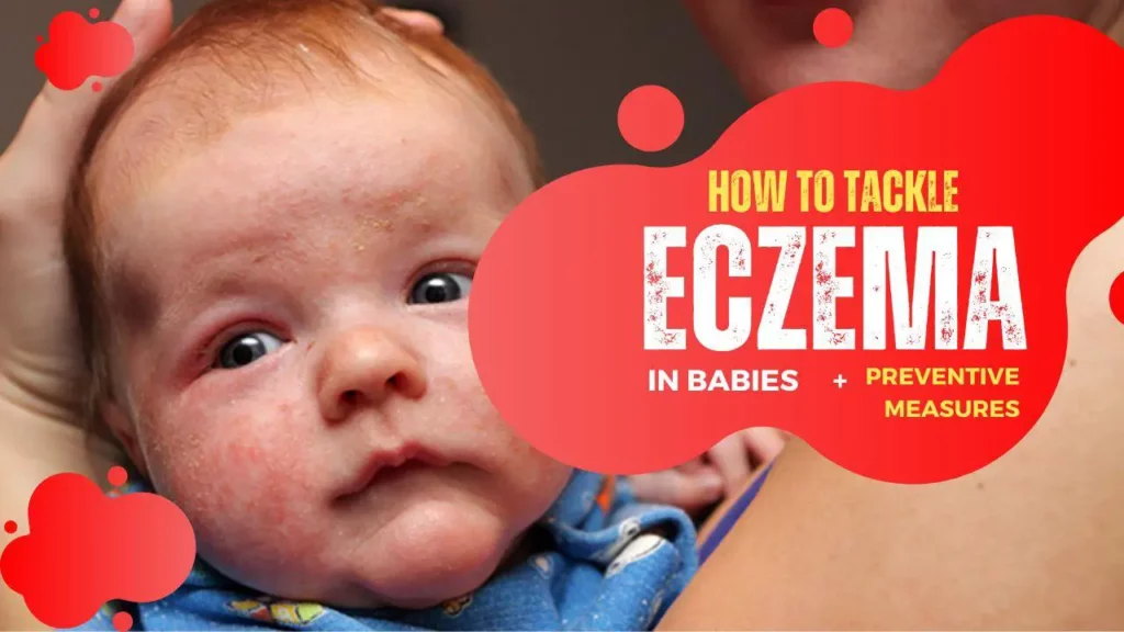 How to tackle eczema in babies - Baby Eczema Flare Ups - babyjourney.net
